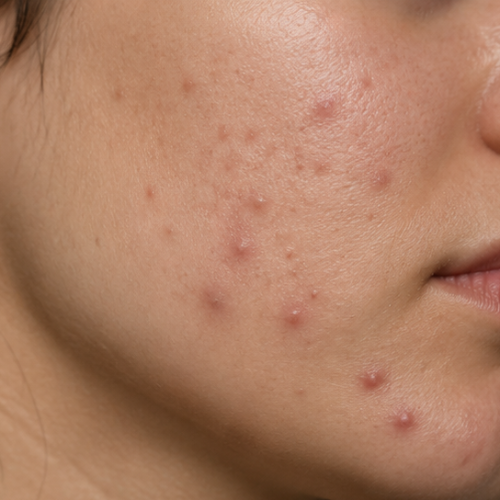 acne acne