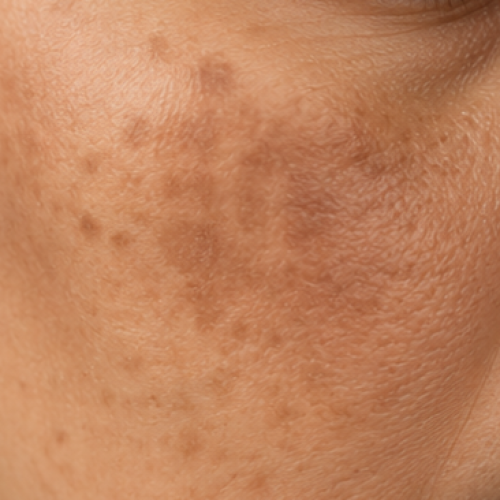 pigmentation pigmentation
